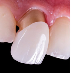 Teeth Whitening At Home: DIY Vs. Professional Treatment